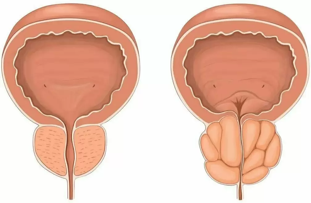 Здрава простата и простатитис